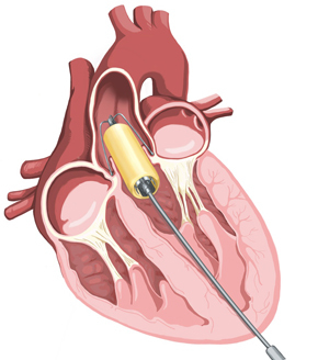 Heart of the design: This illustration shows the deployment device for the UCT-developed heart valve, which will allow the insertion of a trans-catheter valve not only without open heart surgery, but under simple conditions and without obstructing the blood flow out of the heart during the procedure. (Image courtesy of Prof Peter Zilla.)