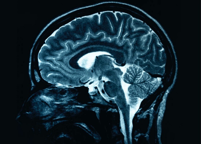 An MRI scan of a human brain.