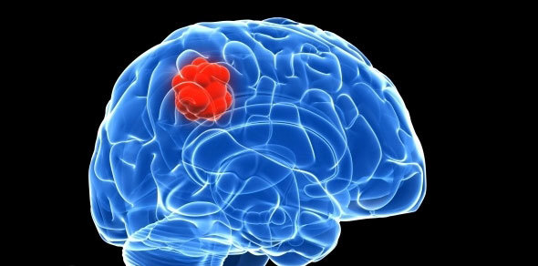 A rare genetic cancer syndrome can cause aggressive tumours in the brain in children.