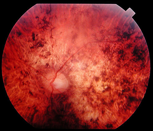 Fundus of a 34 year-old patient with cone rod dystrophy due to Spinocerebellar Ataxia Type 7 (SCA7). Note that the macular area, and also the mid periphery, are atrophic. <a href="http://en.wikipedia.org/wiki/Cone_dystrophy#/media/File:Fundus_of_a_patient_with_cone_rod_dystrophy.png" target="_blank">Photo courtesy of Christian P Hamel – Orphanet J Rare Dis. 2007; 2: 7</a>, accessed via Wikimedia Commons. 