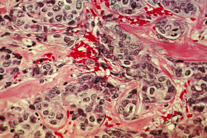 A histological slide of cancerous breast tissue. The pink “river ways” are normal connective tissue; the dark grains are cancer cells.