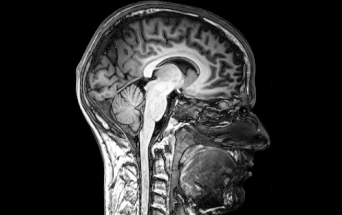 MRI brain sagittal section by Adrian Neumann, licensed under Creative Commons Attribution-Share Alike 2.0 via Wikimedia Commons.