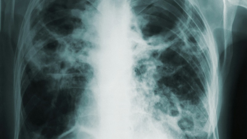 In 2023, more than 10 million people fell ill with TB, causing 1.25 million deaths annually.
