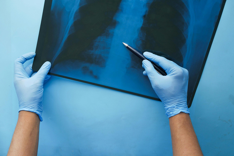 Research found that 80% of participants with TB were asymptomatic. And more than half of this group of responders also presented with chest X-rays that showed no traces of active disease. 