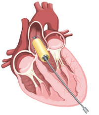 UCT-developed heart valve