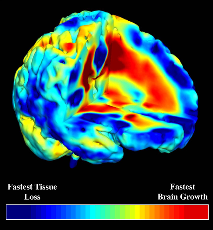 Brain of MRI scan data for child onset schizophrenia showing areas of brain growth and loss of tissue (Credit: National Institute of Mental Health)