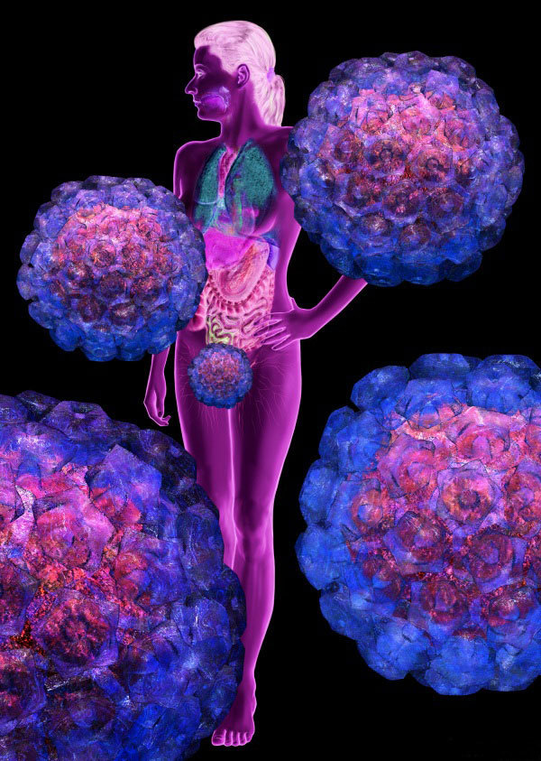 Graphic of the human papillomavirus, the cause of cervical cancer, by <a href="http://rkm.com.au/" target="_blank">Russell Kightley Media</a>, based in Canberra, Australia.