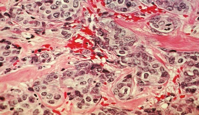 A histological slide of cancerous breast tissue.