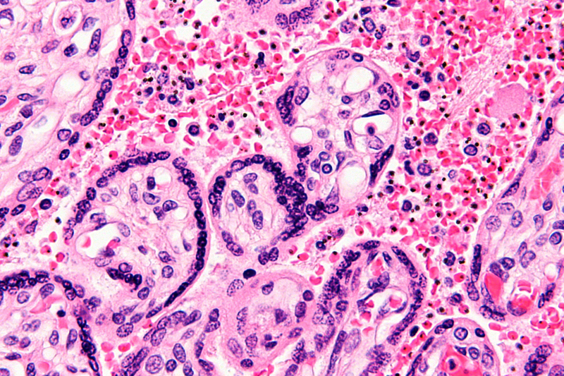 Micrograph of a placenta from a stillbirth due to maternal malaria.