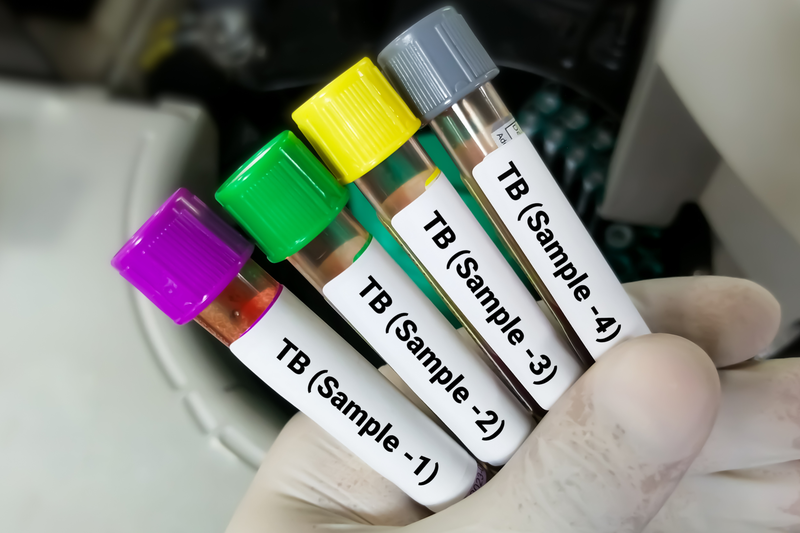 A groundbreaking study found that the turnaround time for full TB diagnosis and resistance testing has gone from 15 days to just 23 hours.
