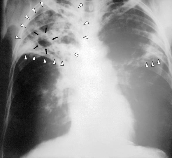 An anteroposterior X-ray of a patient diagnosed with advanced bilateral pulmonary tuberculosis. This AP X-ray of the chest reveals the presence of bilateral pulmonary infiltrate (white triangles), and "caving formation" (black arrows) present in the right apical region.The diagnosis is far-advanced tuberculosis. (Image courtesy of <a href="http://www.cdc.gov/" target="_blank">Centers for Disease Control and Prevention's</a> Public Health Image Library.)