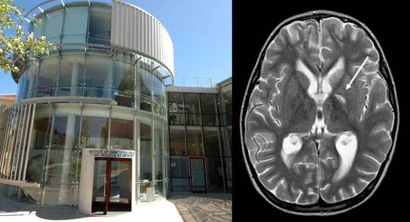 Left: Institute of Infectious Disease and Molecular Medicine (IDM) at UCT which is home to the Wellcome Centre for Infectious Diseases Research in Africa (CIDRI-Africa). Right: MRI scan of tuberculosis meningitis patient reveals a loss of blood supply to part of the brain (white patch highlighted by the white arrow) 