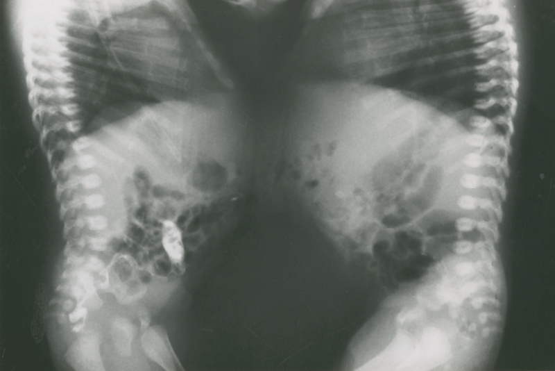 This X-ray of a pair of conjoined twins is part of a collection of clinical photographs recently digitised by the UCT Pathology Learning Centre. These twins, who were joined at the abdomen, were later successfully separated in the first operation of its kind in South Africa at the Red Cross Children’s Hospital in 1966.