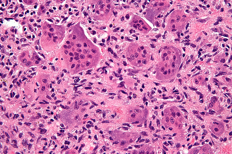 Very high magnification micrograph of a tumour cell.