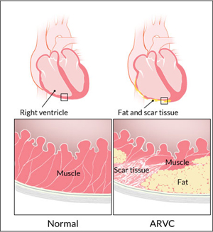 UCT researchers discover heart-attack gene