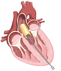 Valve heart