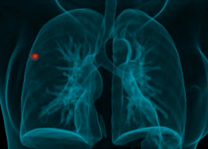 A 3D reconstruction of a fused 18F-fluoro-deoxyglucose positron emission tomography and computed tomography (FDG-PET/CT) scan for an asymptomatic woman with HIV-1 infection shows evidence of immune sensitisation by Mycobacterium tuberculosis. Photo Hanif Esmail .