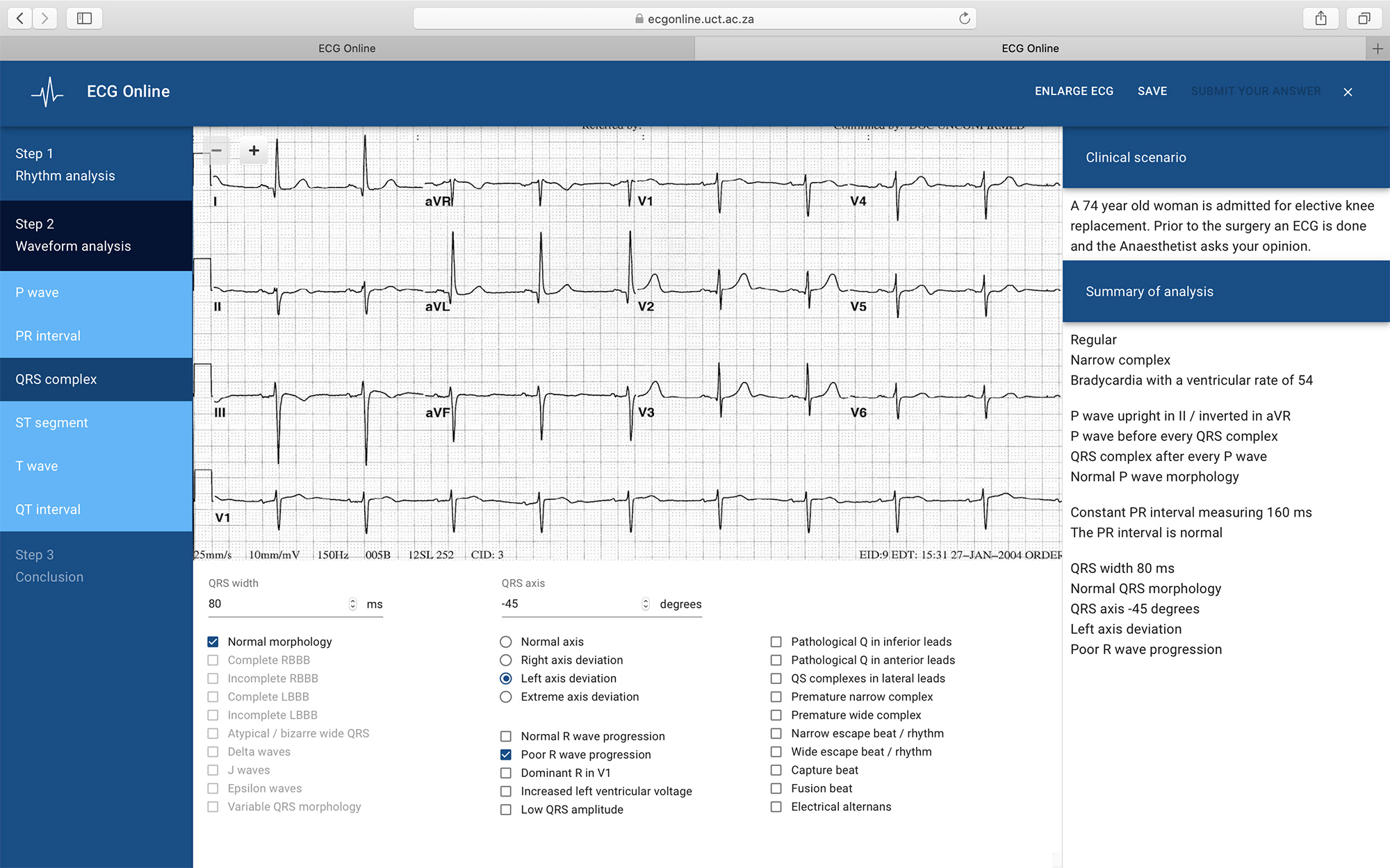 Analysing an ECG online